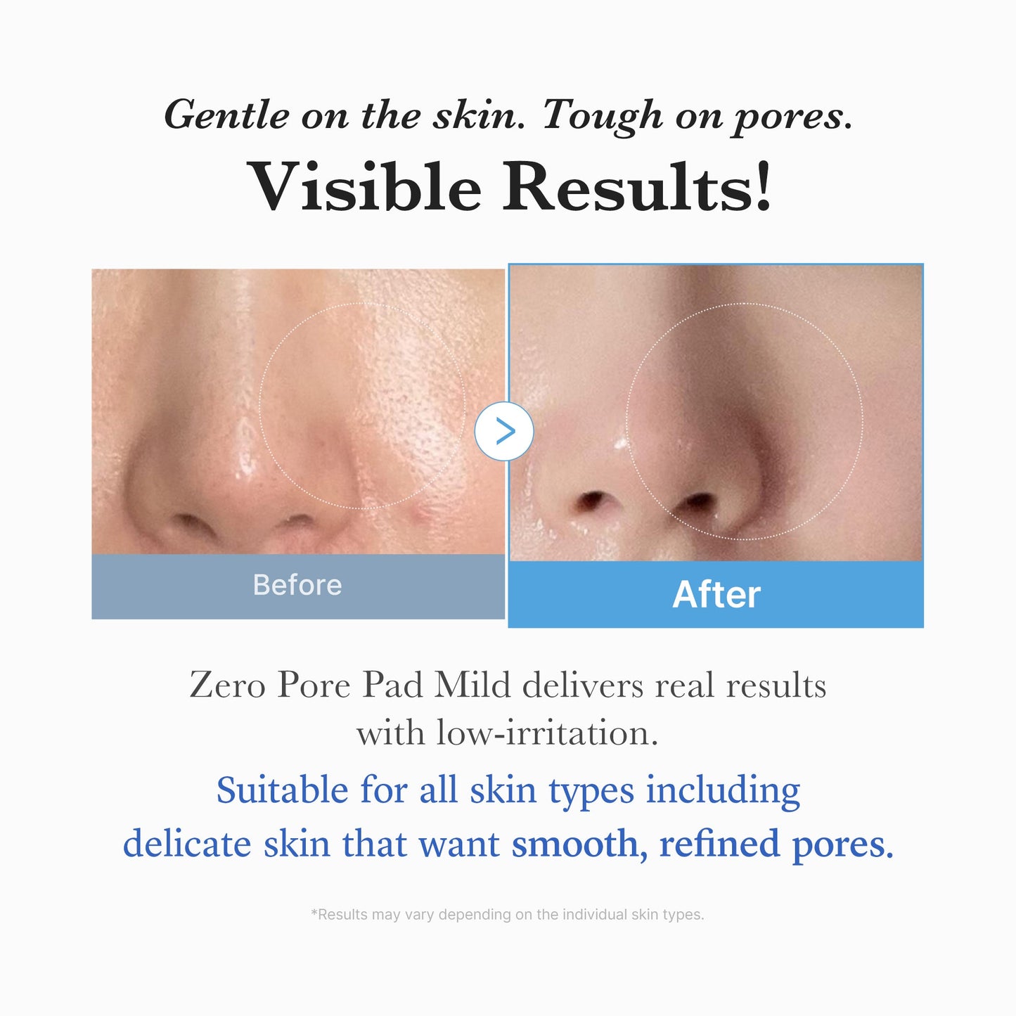 zero-pore-madecassoside-pads-mild-v9 04_6357f9f9-483b-4891-82c6-a58d336e62c8.jpg